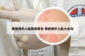 银屑病手心起都是黄包 银屑病手上起小水泡