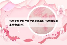 怀孕了牛皮癣严重了孩子能要吗 怀孕期间牛皮癣会减轻吗