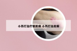 小苏打治疗银屑病 小苏打治皮癣