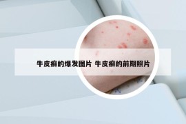 牛皮癣的爆发图片 牛皮癣的前期照片