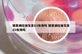 银屑病吃维生素D3有用吗 银屑病吃维生素d3有用吗