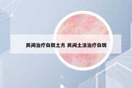 民间治疗白斑土方 民间土法治疗白斑