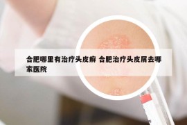 合肥哪里有治疗头皮癣 合肥治疗头皮屑去哪家医院