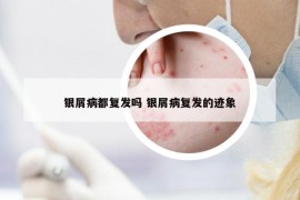银屑病都复发吗 银屑病复发的迹象