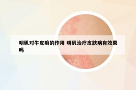 明矾对牛皮癣的作用 明矾治疗皮肤病有效果吗