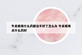 牛皮癣用什么药都治不好了怎么办 牛皮癣用点什么药好
