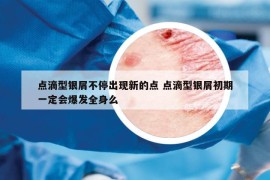 点滴型银屑不停出现新的点 点滴型银屑初期一定会爆发全身么