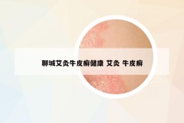 聊城艾灸牛皮癣健康 艾灸 牛皮癣