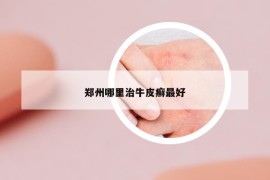 郑州哪里治牛皮癣最好