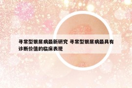 寻常型银屑病最新研究 寻常型银屑病最具有诊断价值的临床表现