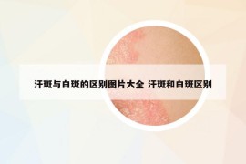 汗斑与白斑的区别图片大全 汗斑和白斑区别