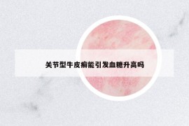 关节型牛皮癣能引发血糖升高吗