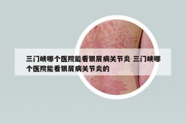 三门峡哪个医院能看银屑病关节炎 三门峡哪个医院能看银屑病关节炎的