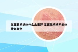 掌跖脓疱病吃什么水果好 掌跖脓疱病不能吃什么食物