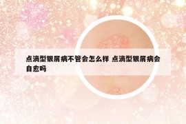 点滴型银屑病不管会怎么样 点滴型银屑病会自愈吗