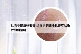 达克宁酮康唑乳膏 达克宁酮康唑乳膏可以治疗妇科病吗