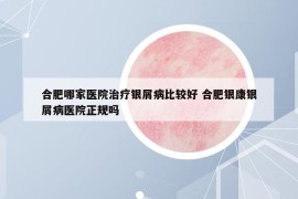 合肥哪家医院治疗银屑病比较好 合肥银康银屑病医院正规吗