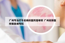 广州专治疗牛皮癣的医院是哪家 广州皮肤医院银屑病专科