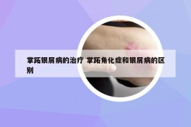掌跖银屑病的治疗 掌跖角化症和银屑病的区别