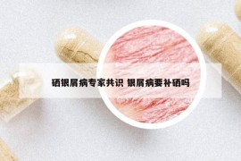 硒银屑病专家共识 银屑病要补硒吗