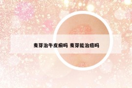 麦芽治牛皮癣吗 麦芽能治癌吗