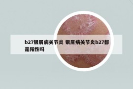 b27银屑病关节炎 银屑病关节炎b27都是阳性吗
