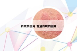 白斑的图片 普通白斑的图片