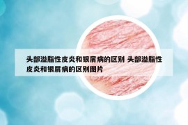 头部溢脂性皮炎和银屑病的区别 头部溢脂性皮炎和银屑病的区别图片