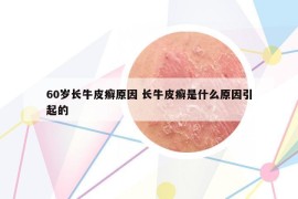 60岁长牛皮癣原因 长牛皮癣是什么原因引起的