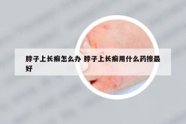 脖子上长癣怎么办 脖子上长癣用什么药擦最好