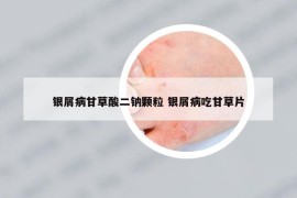 银屑病甘草酸二钠颗粒 银屑病吃甘草片