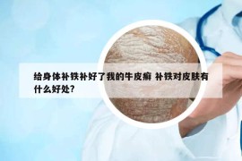 给身体补铁补好了我的牛皮癣 补铁对皮肤有什么好处?