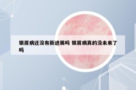 银屑病还没有新进展吗 银屑病真的没未来了吗