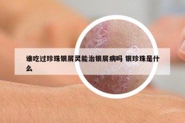 谁吃过珍珠银屑灵能治银屑病吗 银珍珠是什么