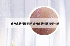 达州皮肤科那家好 达州皮肤科医院哪个好