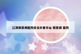辽源银屑病医院应当长春华山 银屑病 医院