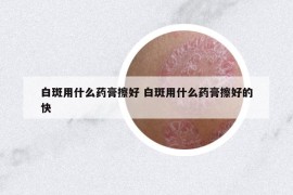 白斑用什么药膏擦好 白斑用什么药膏擦好的快