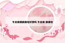 牛皮癣摸酮康唑好使吗 牛皮癣 酮康唑
