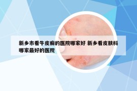 新乡市看牛皮癣的医院哪家好 新乡看皮肤科哪家最好的医院