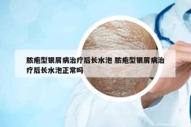 脓疱型银屑病治疗后长水泡 脓疱型银屑病治疗后长水泡正常吗