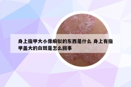 身上指甲大小像癣似的东西是什么 身上有指甲盖大的白斑是怎么回事