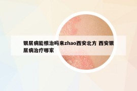 银屑病能根治吗来zhao西安北方 西安银屑病治疗哪家