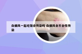 白癞风一起吃饭会传染吗 白癞风会不会性传染