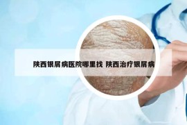陕西银屑病医院哪里找 陕西治疗银屑病