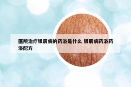 医院治疗银屑病的药浴是什么 银屑病药浴药浴配方