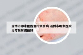 淄博市哪家医院治疗银屑病 淄博市哪家医院治疗银屑病最好
