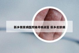 新乡银屑病医院确寻杨淑莲 新乡皮肤病