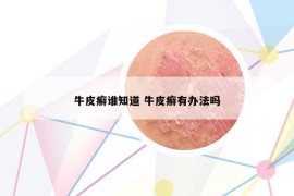 牛皮癣谁知道 牛皮癣有办法吗