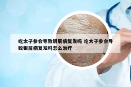 吃太子参会导致银屑病复发吗 吃太子参会导致银屑病复发吗怎么治疗