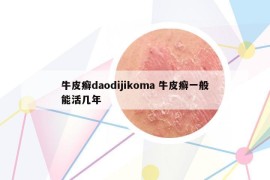 牛皮癣daodijikoma 牛皮癣一般能活几年